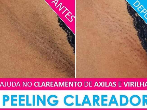 clareamento-virilha-axilas-3005-5953_2